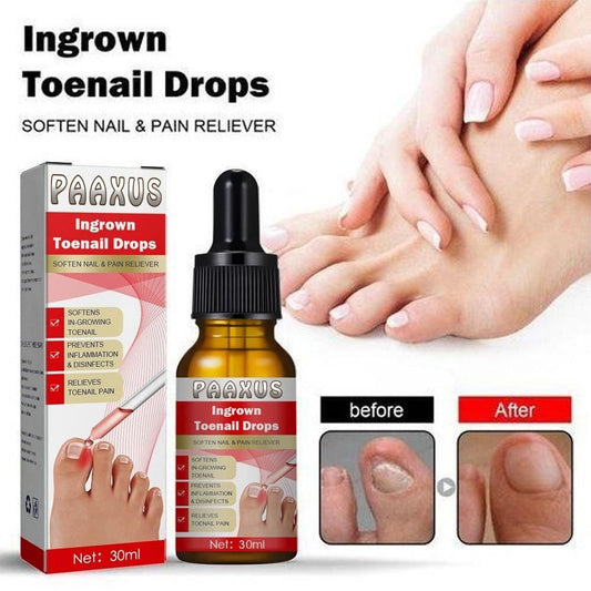 Ingrown Toenail Drops (buy 1 get 1 free)