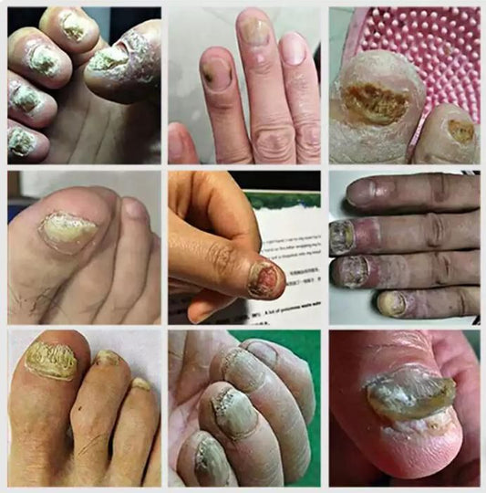 Ingrown Toenail Drops (buy 1 get 1 free)