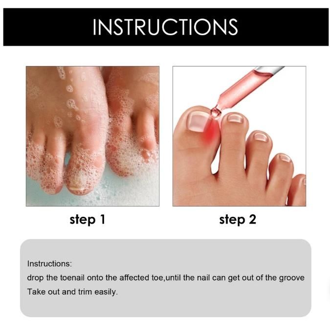 Ingrown Toenail Drops (buy 1 get 1 free)